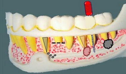 Complicații după umplerea canalului - enciclopedie dentară