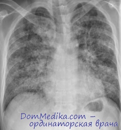 Sindromul de detresă respiratorie acută