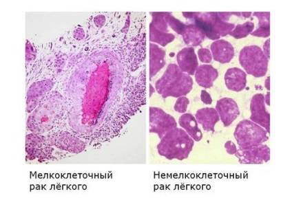 Primele semne ale cancerului pulmonar cancer pulmonar, diagnosticul și factorii care contribuie la dezvoltare