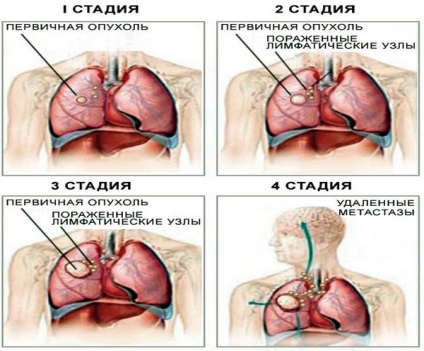 Primele semne ale cancerului pulmonar cancer pulmonar, diagnosticul și factorii care contribuie la dezvoltare