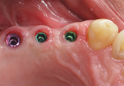 Efectele secundare ale implantului dentar, totul despre implanturile dentare și implantologia