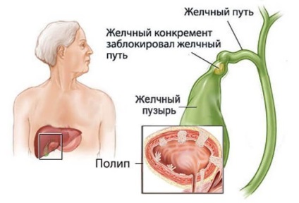 Polipii din specia vezicii biliare, cauze, simptome și tratament