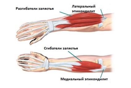 Deteriorarea ligamentelor articulației cotului, ruptura tratamentului articulațiilor ligamentului în conformitate cu Bubnovsky
