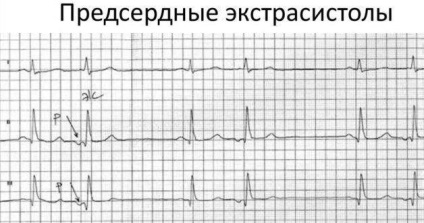 Extracistul atrial pe ect