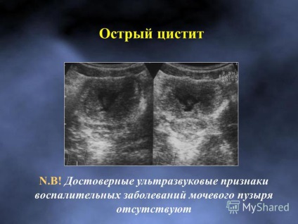 Prezentarea anatomiei normale și ultrasunete a vezicii urinare