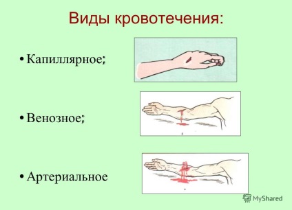 Prezentarea metodelor de stopare a sângerărilor