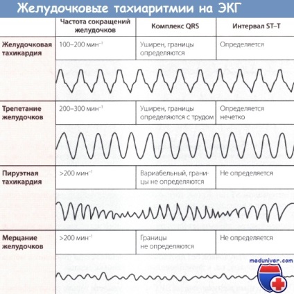 Cauzele morții subite de stop cardiac