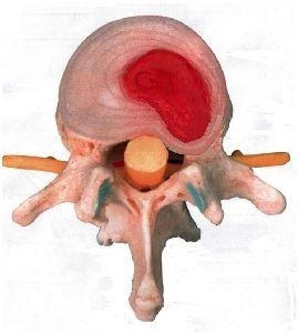 Retrovolteza vertebrelor l5