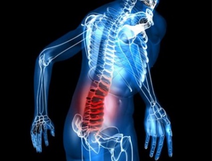 Retrolisthesis csigolyák L3, L4, L5 okok, tünetek, típusok, a kezelés