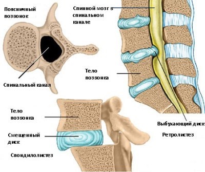 Retrolistesis - deplasarea vertebrelor înapoi