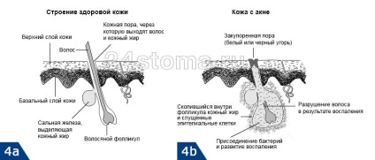 Acid salicilic din acnee - recenzii, sfaturi ale unui cosmetolog