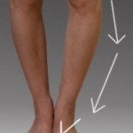 Sindromul descrierii tractului ileal-tibial