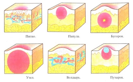 Erupție pe corp (față, mâini, abdomen) - cauze și tratament