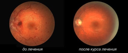 Scleroza tratamentului vaselor oculare în cursul bolii și tratamentul acesteia