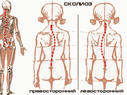 Scolioza coloanei vertebrale toracice - simptome, grade, tratament, exerciții, fotografie