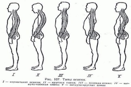 Scolioza coloanei vertebrale toracice - simptome, grade, tratament, exerciții, fotografie