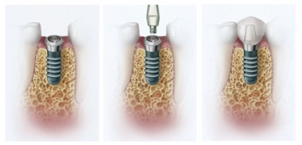 Mennyi túléli implantátum a felső állkapocsban