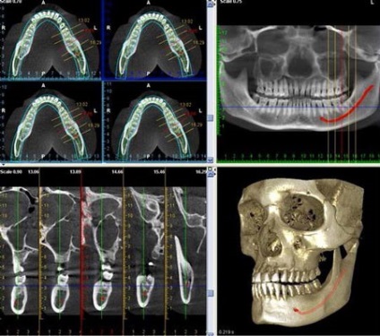 Mennyi túléli implantátum a felső állkapocsban