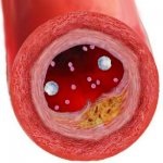 Reducerea colesterolului în sânge