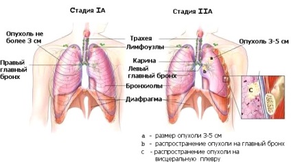 Etapele cancerului pulmonar și terapia eficientă