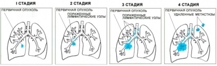 Etapele cancerului pulmonar și terapia eficientă