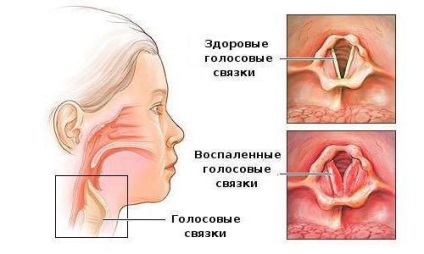 Laringita cauzatoare de stenoza, simptome, diagnostic si tratament