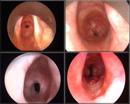 Laringita cauzatoare de stenoza, simptome, diagnostic si tratament