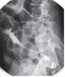 Stentul intestinului gros ca etapă de tratament a obstrucției obstructive a colonului