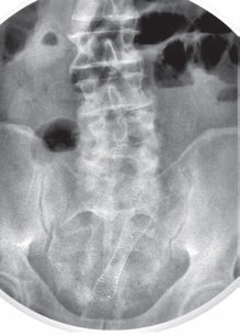 Stentul intestinului gros ca etapă de tratament a obstrucției obstructive a colonului