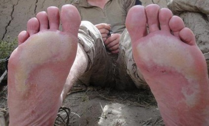 Sifon picior - boala neplăcută a picioarelor umede și înghețate