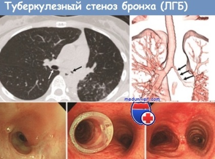 Tuberculoza bronhiilor, traheei și tractului respirator superior - clinică, diagnostic