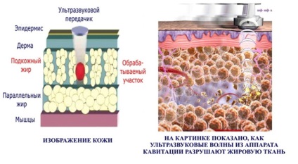 Conceptul de cavitație cu ultrasunete, metodologie, recomandări