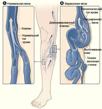 Varice - defecte cosmetice sau boli grave, vivasan (Togliatti)