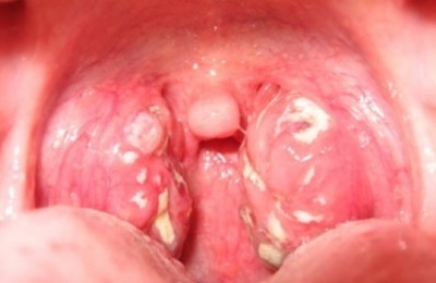 În gât, particule albe cu miros neplăcut ce este, cauze și tratament