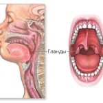 Inflamația amigdalelor în cauzele și tratamentul gâtului