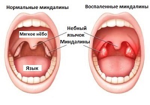 Inflamația amigdalelor în cauzele și tratamentul gâtului