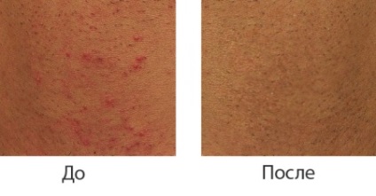 Benőtt szőrszál epilálást követően (36 fotó), hogy megszabaduljon a benőtt szőrszál, szerek