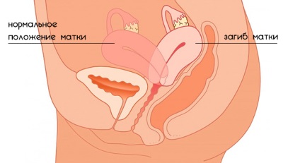 Îndoirea cauzelor uterine și consecințele patologiei