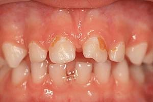A fogak gyermekeknél 3-6 éves