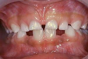A fogak gyermekeknél 3-6 éves