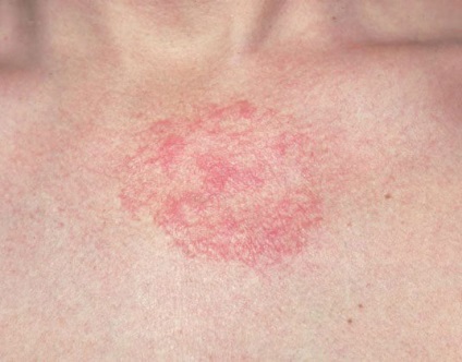 5 Salvarea home remedii pentru dermatita