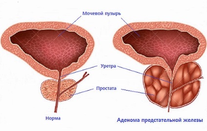 Adenomul prostatei la bărbați simptome, cauze, efecte, tratament