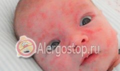 Alergia pe fața unui copil - alergii
