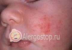 Alergia pe fața unui copil - alergii