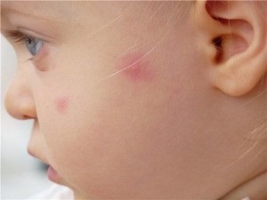 Allergiás a falatok a szúnyogok, a tünetek és kezelések