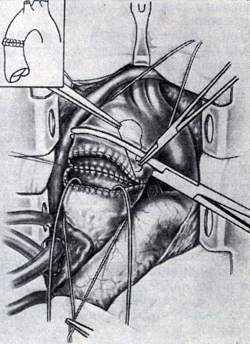 boncoló aneurysma