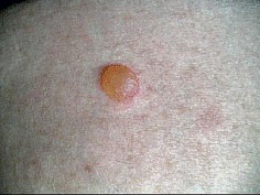 Hólyagos dermatitis okai, tünetei, diagnózisa és kezelése