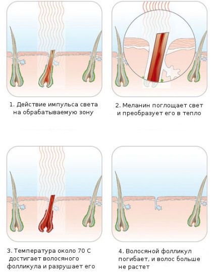 Ceea ce distinge epilarea de depilare este descrierea metodelor, eficienței și limitărilor