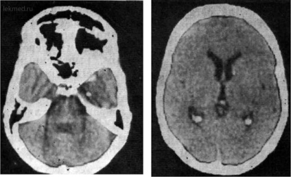 Cysticercoza creierului - tomografie computerizată a creierului