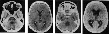 agyi cysticercosis - számítógépes tomográfia agyban